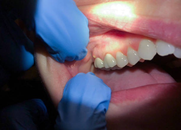 Best Emergency Dental Care for Abscessed Tooth in Harbison Nyon, CA